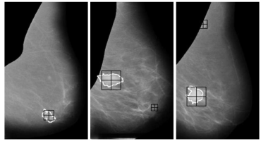 Detected mass in a mammogram