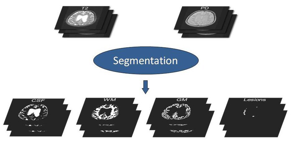 Brain MRI segmentation into tissues and lesions