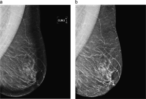 Mammogram before and after peripheral enhancement